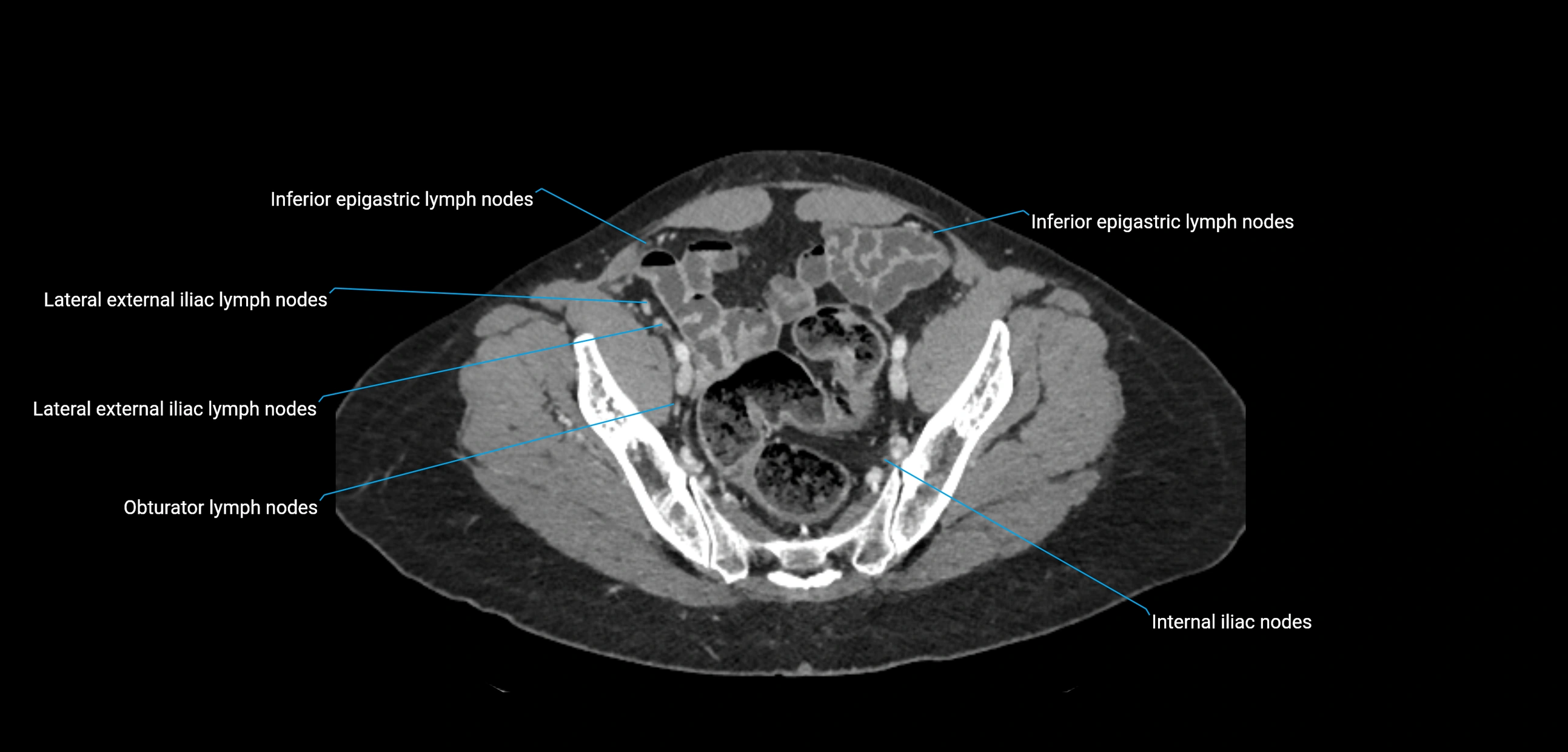 CT ct abdominal lymph nodes  axial cross sectional anatomy  enchanced radiology image -img-00002-00349.webp